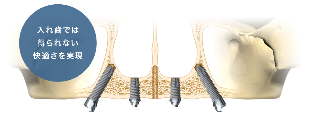 入れ歯のお悩みを解消できる「All-on-4（オールオンフォー）」